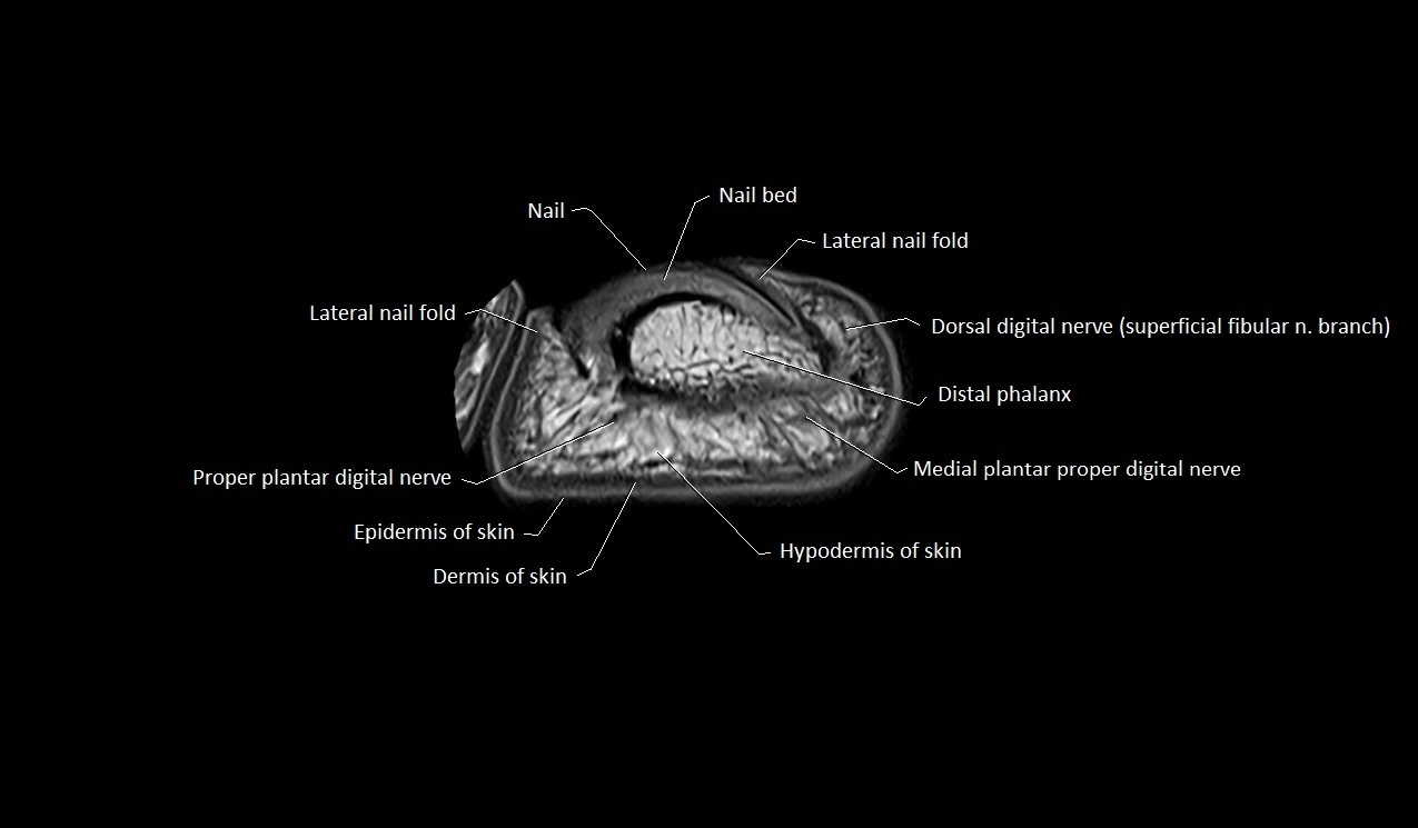 Great toe (hallux) axial microanatomy 3T MRI image 8.webp